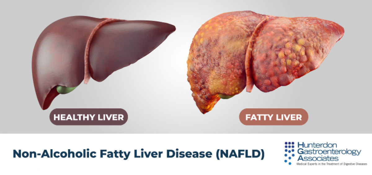 Fatty Liver Disease-30% of us have a fatty liver it can be serious