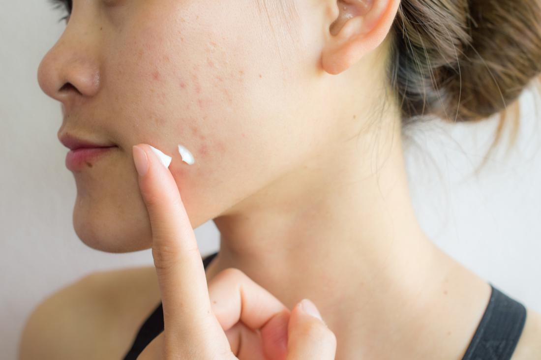 Smooth Skin Strategies: How You Can Fix Acne Scars