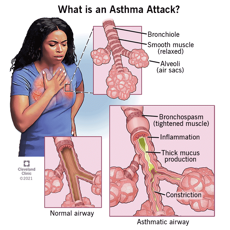 Critical Illness Insurance The Non-Disclosure ProblemRespiratory Ailments: Free Heal Programs for AsthmaCritical Illness Insurance The Non-Disclosure Problem