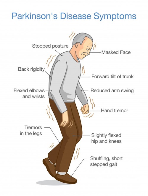 Parkinson’s Disease — Are Some People Predisposed To It?